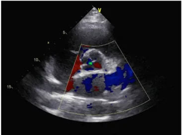 Fig. 3 - Echocardiography of a type D/type III quadricuspid aortic  valve with mild aortic regurgitation.