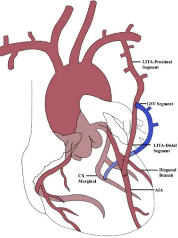 Table 2. Artery of left coronary system revascularized by LITA  and GSV composite graft