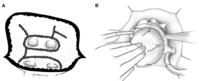 Fig. 2 - Ablation line: (A) unipolar, (B) bipolar.