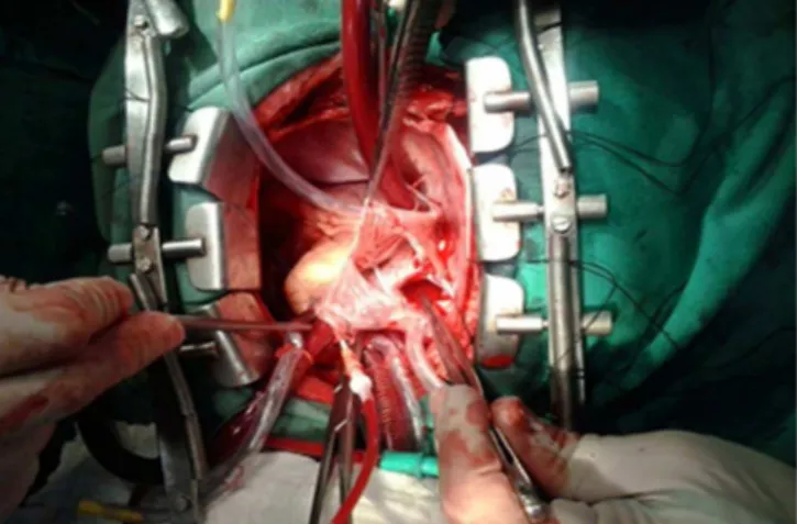 Fig 2 - Left atrium open revealing line of cauterization of the  pulmonary vein ostia.