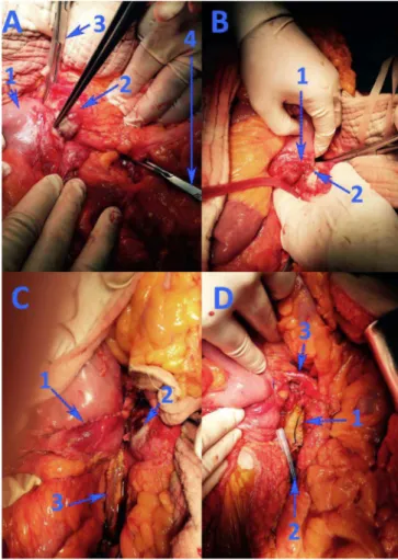 Fig. 1 - Computed tomography images. A – Coronal view showing  the infrarenal abdominal aortic aneurysm (1); B – Anterior to the  aortic aneurysm (1), a pseudoaneurysm (2) can be observed in close  contact with the third and fourth duodenum (1 in image C).