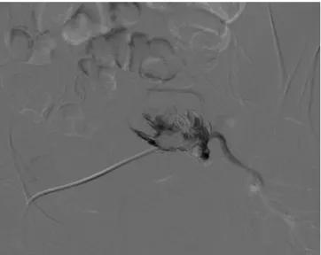 Fig. 2 - Left internal iliac artery aneurysm treatment and internal  iliac artery revascularization with an iliac branch device