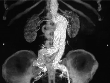 Figure 1). There was a statistically similar distribution in frequency  of endoleaks between the two arteries (x 2 =0.02; P=0.887)