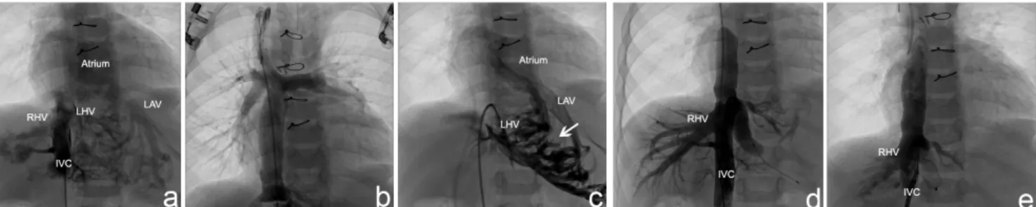 Fig. 1 - A: Angiogram of the inferior vena cava: a veno-venous malformation between the inferior vena cava and the atrium is detected with  a distal collector