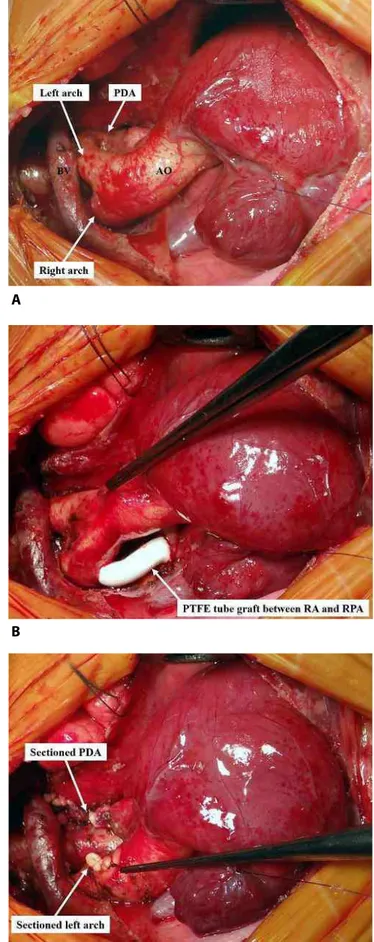 Fig. 2 – (A) Initial aspect of pulmonary atresia with ventricular  septal defect and double aortic arch
