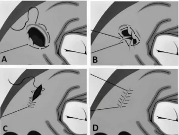 Fig. 4 - Surgical technique. A – Purse-string suture avoiding the left  atrial appendage; B – The purse-string suture is tied up taking care  not to be overtight, because the aim is to delineate the rims, not  to obliterate the orifice completely; C – Fina