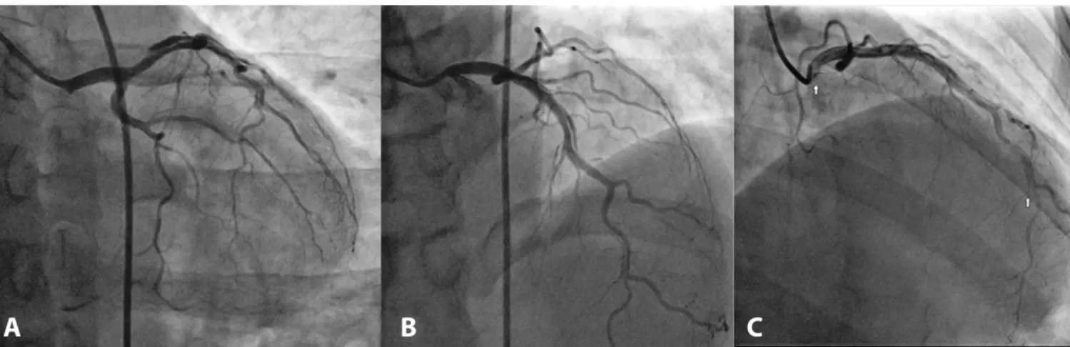 Fig. 2 - Control angiogram three months after the initial episode. (A) Increased dissection flap observed
