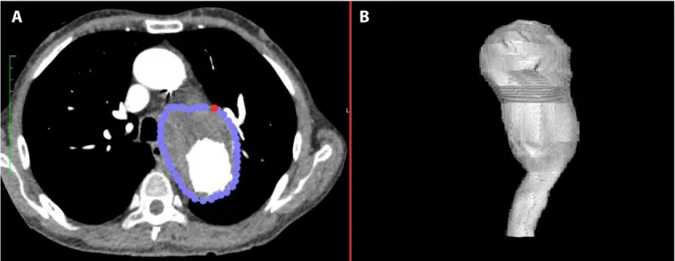 Fig. 2 - Steps of volume calculation: individually placed points delimitates the outer margin of total aorta at each axial image (A); resulting  three-dimensional reconstruction (B).