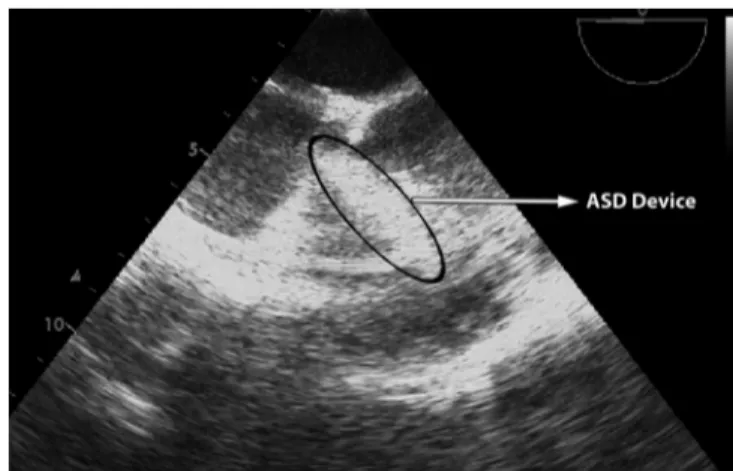 Fig. 1 - Mid oesophagus 0º Four Chamber view showing ASD  device in right ventricular outflow tract.