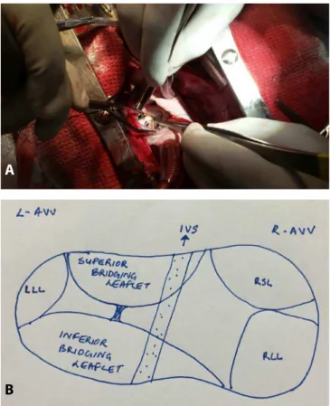Fig. 2 – Competent mitral valve on saline testing after mitral  annuloplasty.