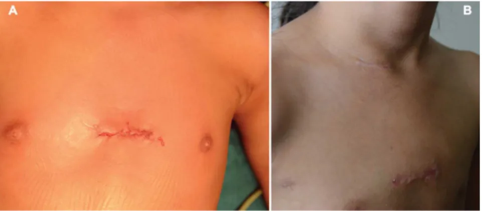 Fig. 4 - Photograph of final sternal wound closure  (A) and healed scar cervical and sternal (B).