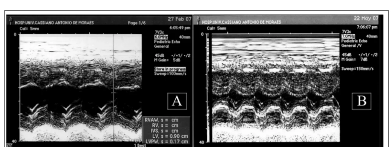 Figura 1 - Imagem ecocardiográfica em modo M do ventrículo esquerdo de gato antes (A) e após (B) tirotoxicose experimental