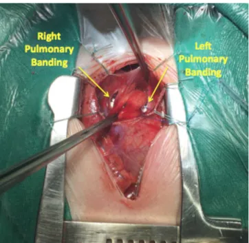Fig. 1 –  Final aspect of the pulmonary banding.