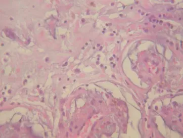 Fig. 2 - Histopathology of resected specimen of left atrial mass  suggestive of myxoma.