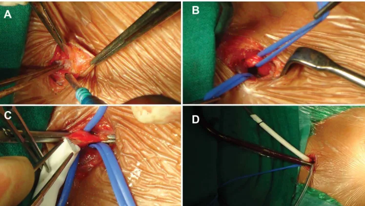 Fig. 2 - Operative photograph showing sequence of cervical cannulation. (A) Cervical incision (B) Looping of common carotid artery and  internal jugular vein (C) Anastomoses of PTFE graft to common carotid artery and (D) Initiation of cardiopulmonary bypas