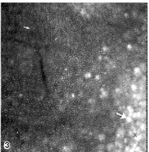 Figure 3. Transverse demineralized section of a non-erupted human deciduous incisor tooth showing dentinal tubule holes (small arrow), giant tubules (large arrow), and interglobular dentin (*)