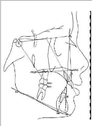 Figure 1. Tracing illustrating anatomic landmarks, points, lines and angles used in this study.