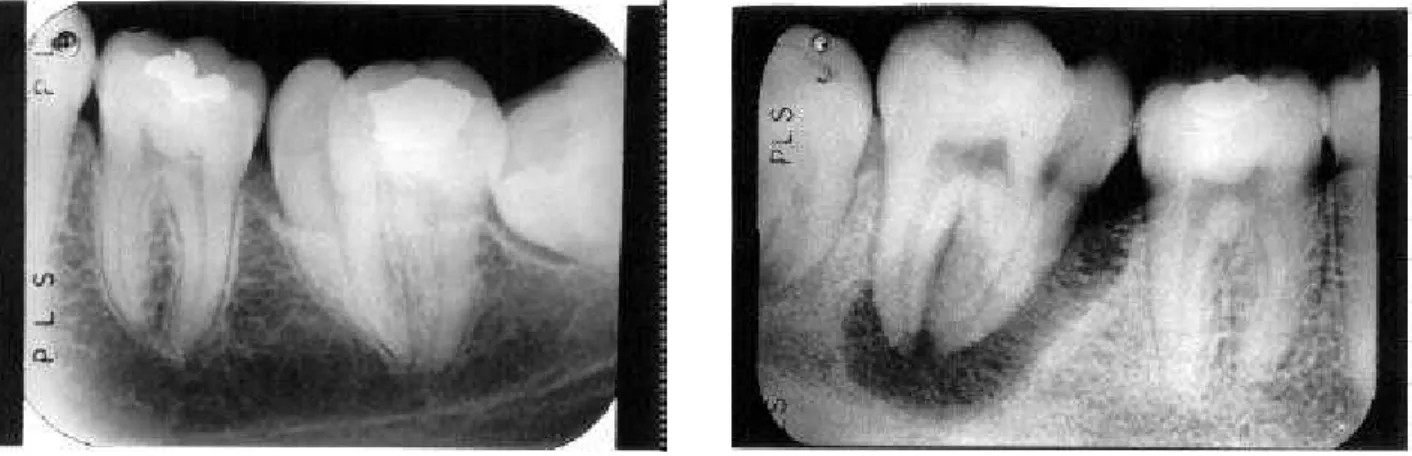 Figure 1. Preoperative radiograph of the fused mandibular second molars and supernumerary teeth