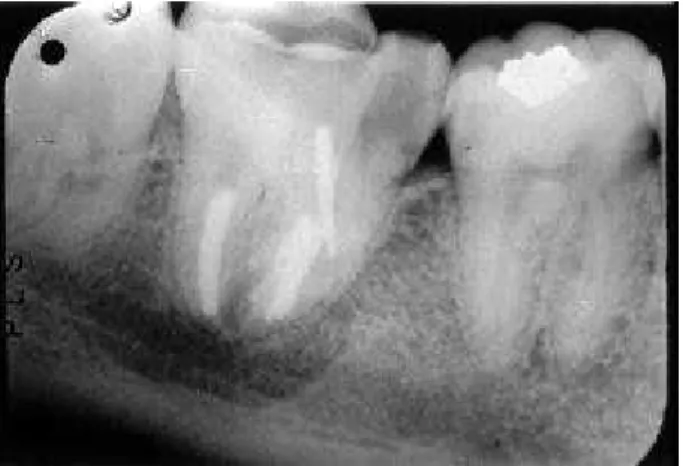 Figure 4. Lateral condensation radiograph. Note that periapical repair has progressed well.