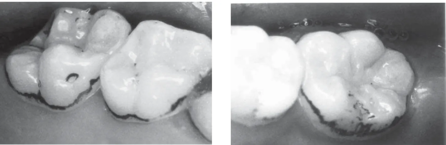 Figure 1. Clinical aspect of black tooth stains. Left panel: score 2 (continuous pigmented lines, which were easily observed and limited to half of the cervical third of the tooth surface)