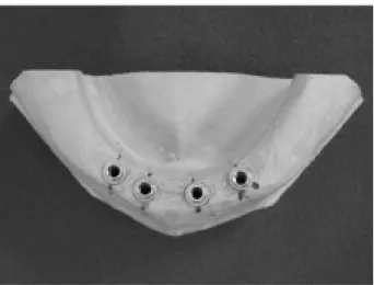Figure 1. Mandible acrylic replica with implants. Figure 2. Master cast with implant analogs.