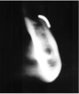 Figure 3. Schematic illustration of the measurements made of the linear tomograph (left) and the panoramic radiograph (right):