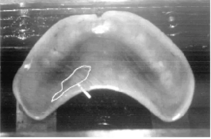 Figure 1. Photograph showing the delimitation of the external limits of the denture.