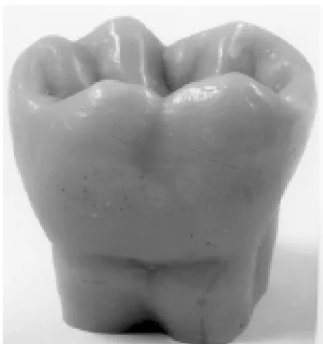 Figure 1. Crown macro model in wax carving of a first mandibular left molar. Lingual view.