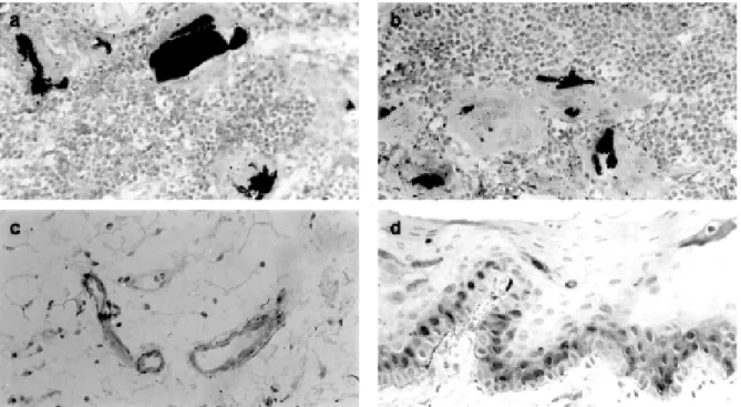 Figure 1. a) Large particles of amalgam associated with a dense inflammatory infiltrate of mononuclear cells with some foreign body giant cell formation