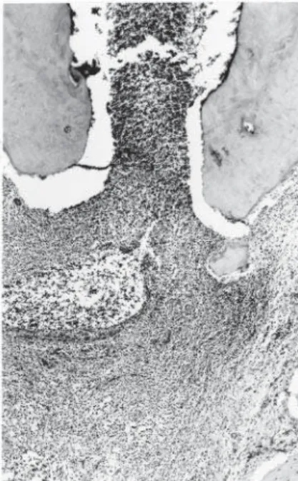 Figure 8. Group VI. Interstitial tissue at the apical and periapical region with moderate inflammatory infiltrate and moderate vascular proliferation.