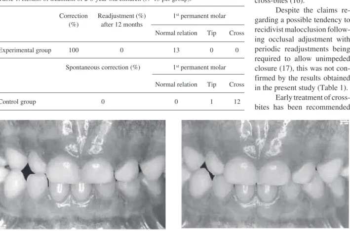 Figure 1. Child with posterior cross-bite before treatment in the maximum habitual intercuspidation position (MHI).