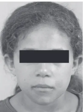 Figure 2. Panoramic radiograph showing multilocular lesions in the mandible. No sign of involvement of the maxilla.