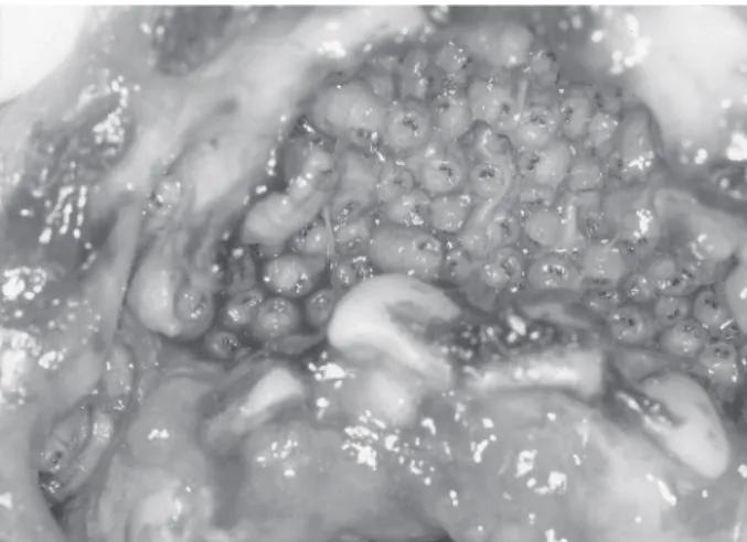 Figure 3. Computerized tomography with intravenous contrast of the maxilla. Gas bubbles are seen in the soft tissue in the anterior maxilla.