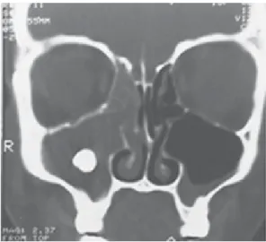 Figure 5. Transverse CT scan showing the presence of secretion inside the right frontal sinus.
