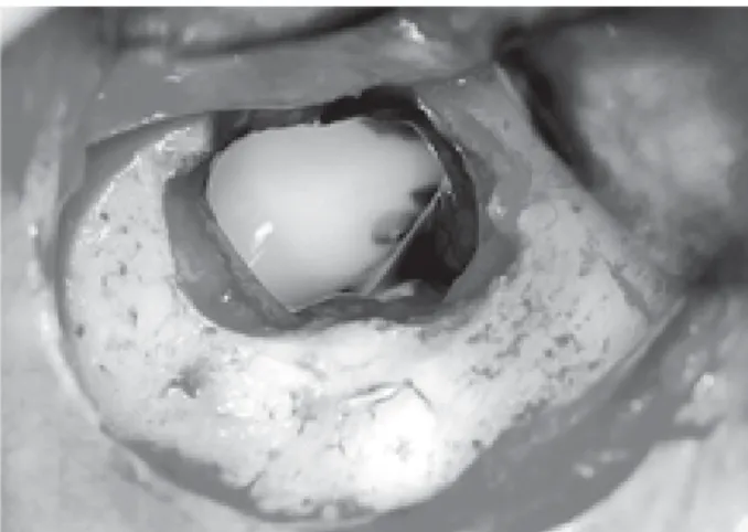 Figure 7. Removal of the displaced tooth through the bone fenestration, by negative pressure of the suction pump.