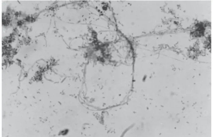 Figure 2. Uncountable cocci, bacilli, filamentous microorganisms, pseudo-hyphae and some neutrophils.