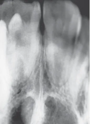 Figure 5. Panoramic radiograph. Figure 6. Periapical radiograph of the maxillary permanent incisors.