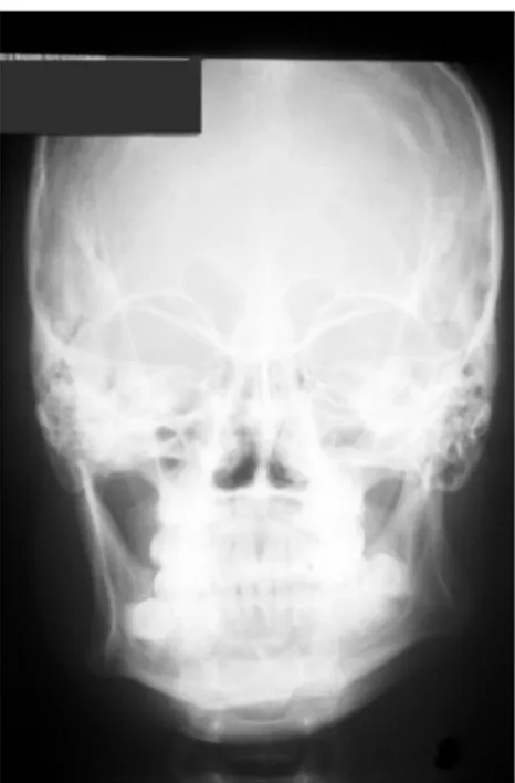 Figure 3. Anteroposterior radiograph showing spur development in the left angle of the mandible.