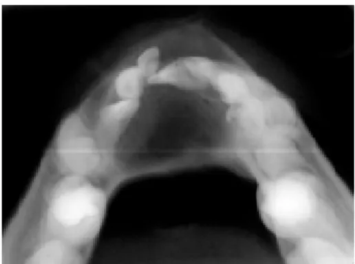 Figure 1. Panoramic radiograph showing a well-defined unilocular radiolucent area in the anterior mandibular region and divergence of the dental roots.