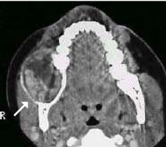 Figure 3. Coronal computed tomography image at bone level showing the relationship between the impacted tooth and the lesion