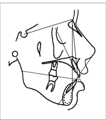 Figure 1. Tracing illustrating the lines, angles, linear and angles measurements used in this study for evaluation of the dental pattern.