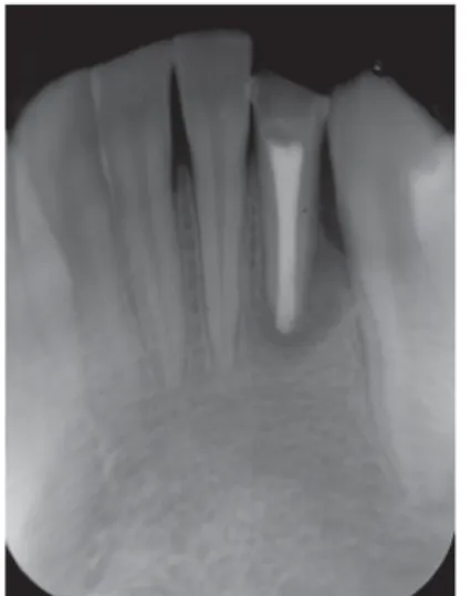 Figure 3. Radiograph showing the apical plug of MTA. Figure 4. Post obturation radiograph, final result.