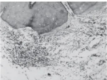 Figure 4. Endomethasone without plug. Presence of Gram- Gram-positive and Gram-negative microorganisms  in the cementum tissue (arrows)
