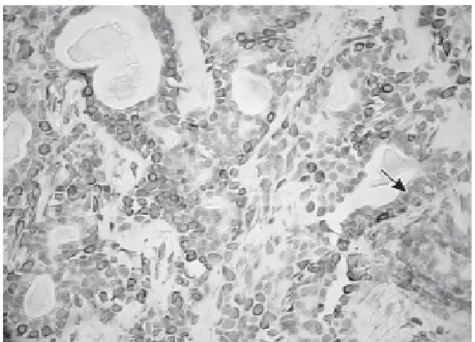 Figure 1. Pleomorphic adenoma: strong citoplasmatic immunoreactivity of vimentin in outer cells of tubular and  duct-like structures