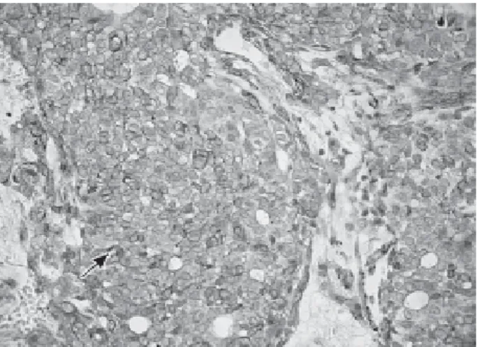 Figure 6.  Polymorphous low-grade adenocarcinoma showing calponin expressed by neoplastic cells (SABC original magnification ×400).