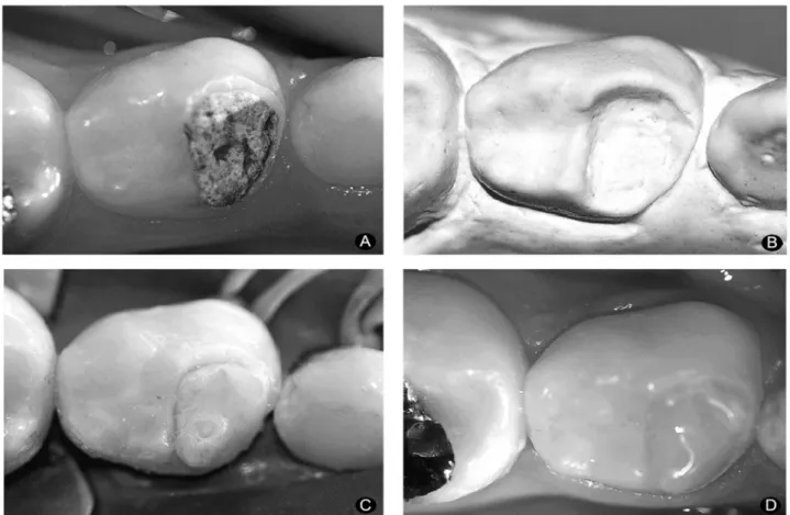 Figure 1. A= Initial clinical aspect; B= Cast model; C= Fragment bonded to the tooth; D= Final aspect of the restoration.