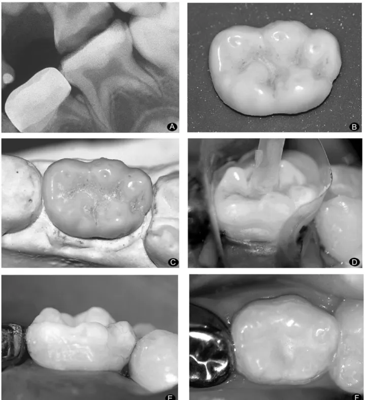 Figure 2. A= Initial interproximal radiograph; B= Tooth fragment; C= Fragment adapted to cast model; D= Fragment bonded to the tooth; E= Correction with composite resin; F= Final aspect after sealant application.