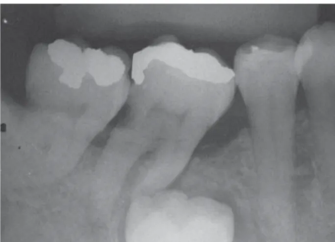 Figure 1. Panoramic radiograph showing radiolucency in the furcation area of the mandibular right second molar and a communication from the periodontal pocket on mesial side of mandibular right second molar to the follicular space associated with the crown