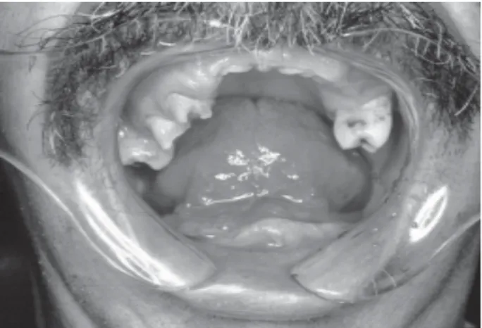 Figure 1. Mandibular and maxilar arches: teeth absence, residual roots, remaining teeth.