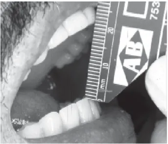 Figure 4. Measurement of mouth opening after oral rehabilitation.
